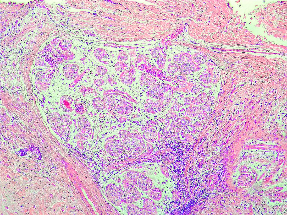 DrAlessandroIac's tweet photo. #AcinicCell #Carcinoma of the #Breast. Cell with granular cytoplasm and sometimes #ClearCells. #BreastPath #pathology #breastcancer https://t.co/x8w4P8Xw9r