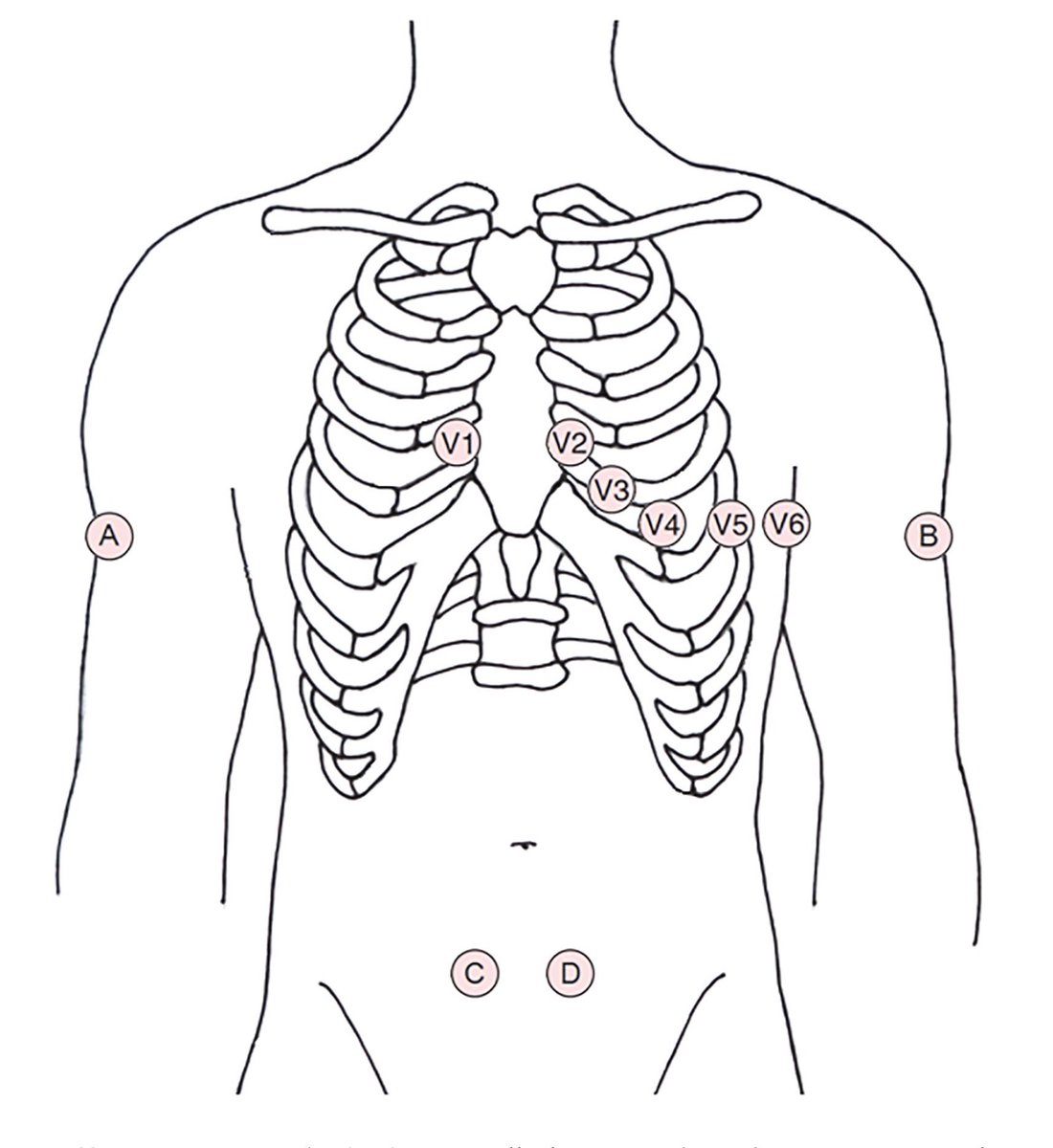 EMSAvenger's tweet photo. The most accurate ECG placement. Study confirms. https://t.co/DtQOphAoC9 #FOAM #FOAMed #ECG #12Lead https://t.co/JDajbSV173