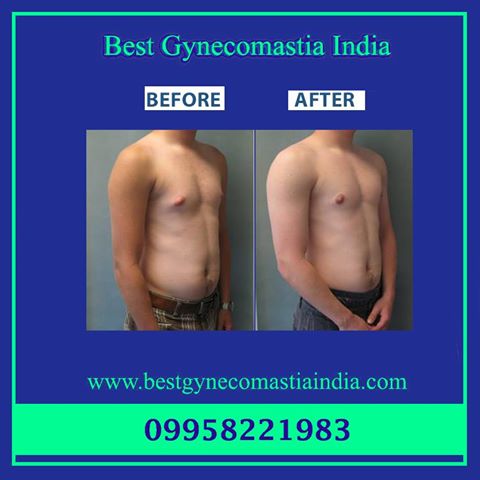 #gynecomastia, #gynecomastiacost, #malebreastreduction, #puffynipplesurgery, #malechestsurgery
Call: 9958221983, 9818369662