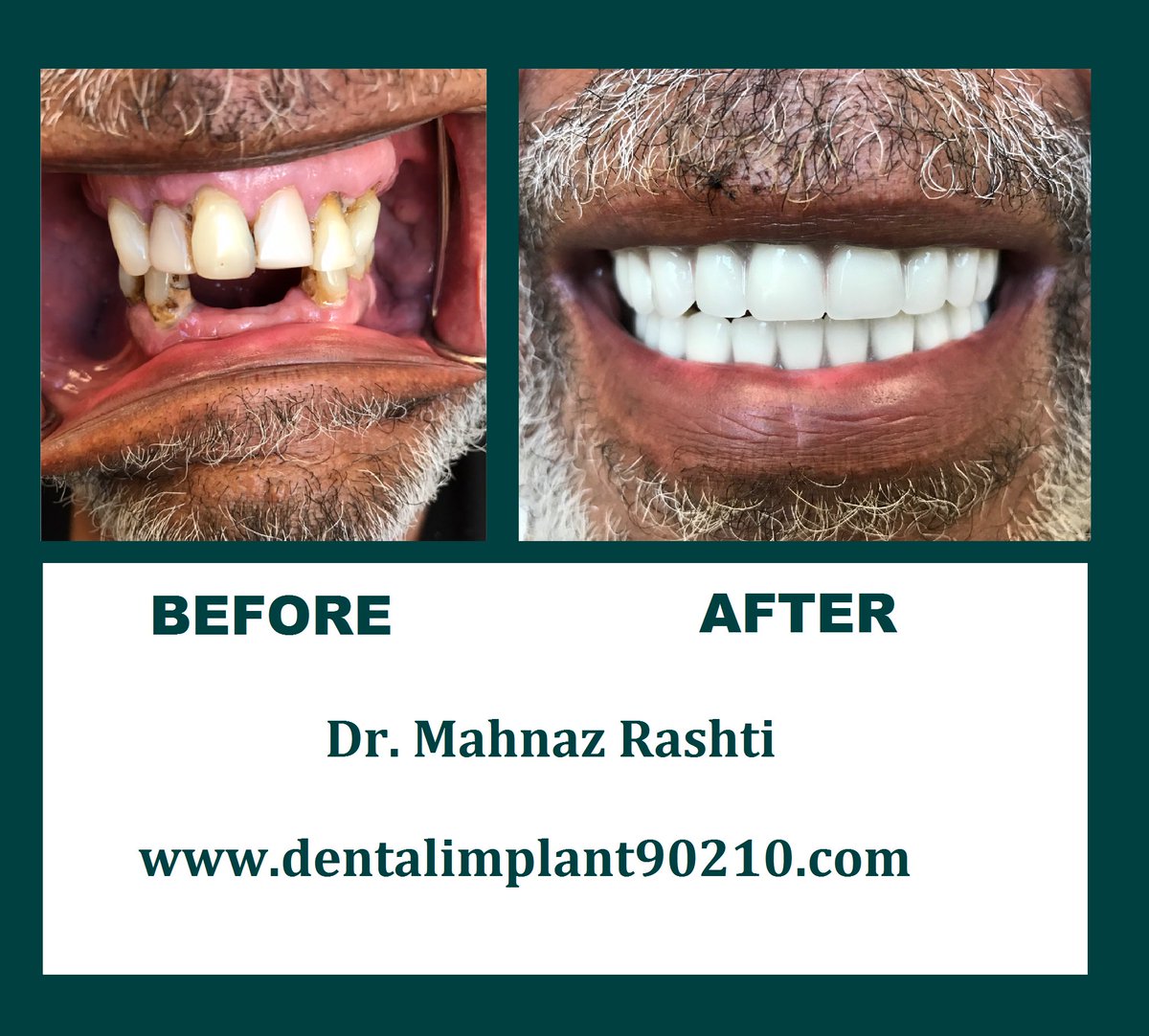 DrRashtiBH's tweet photo. #beforeandafter Dr. Rashti's dental work! Congratulations on your new smile, George! #drrashtidds #beforeandafterteeth https://t.co/iKLG98Z4vi
