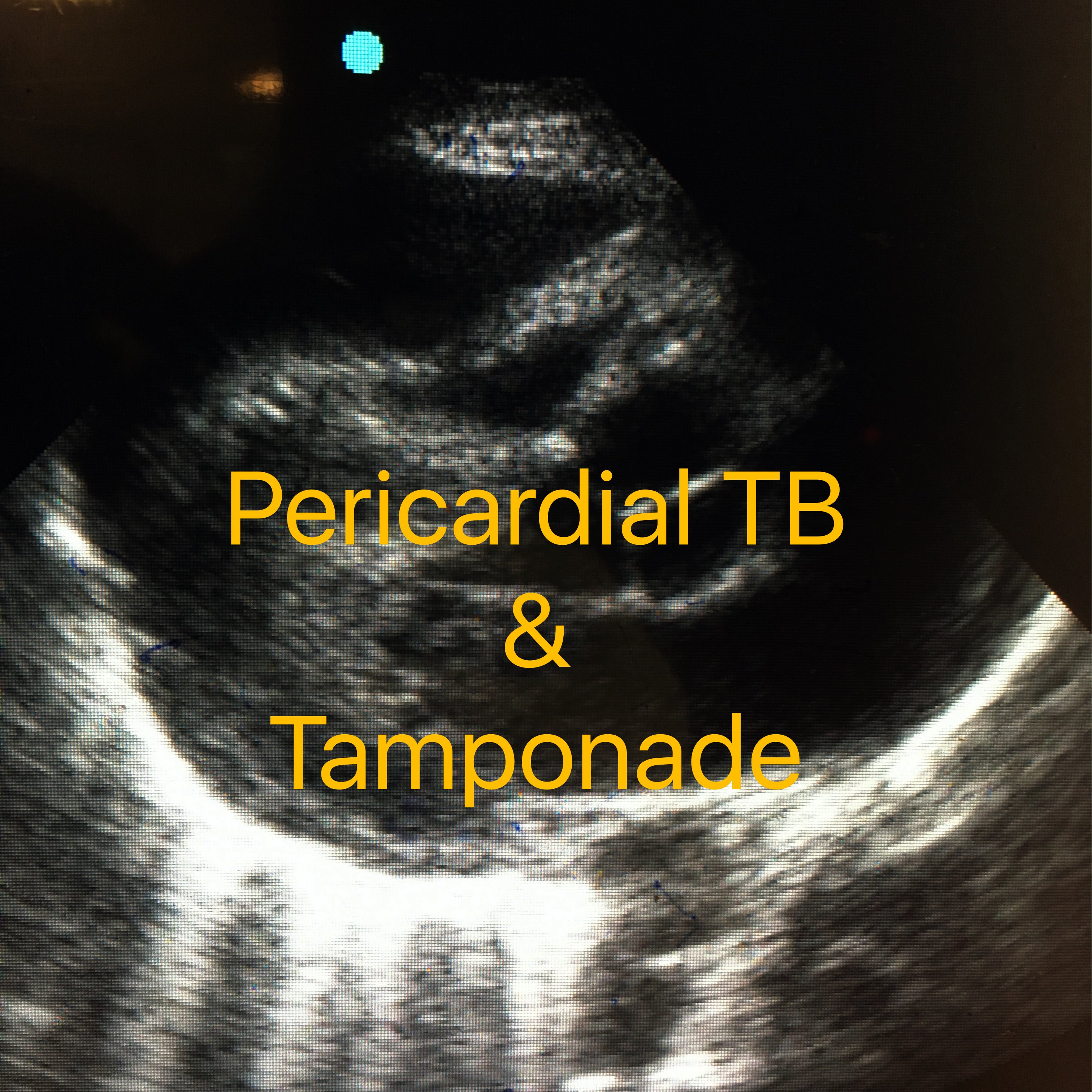 Hennepin Ultrasound  Right Ventricular Strain in Pulmonary Embolism