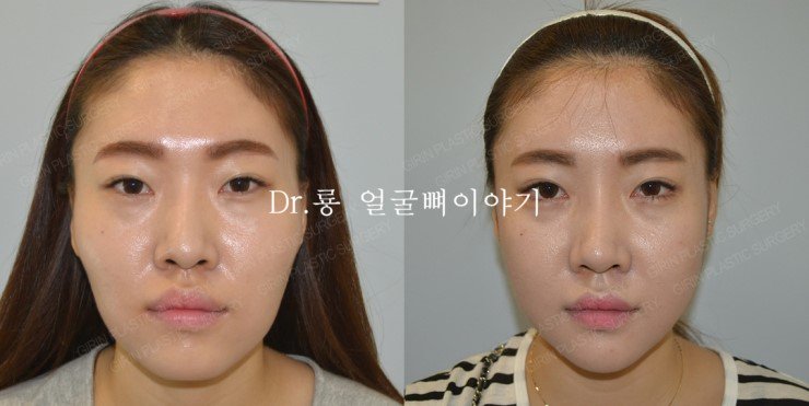 ট ইট র 韓国girin美容整形外科 韓国girin美容整形外科 整形前後写真 顔面輪郭手術 ほうれい線手術 １年３ヶ月目 症状 頬骨発達 広い顎 突き出し口 手術部位 頬骨縮小術 固定装置 ニューvライン ほうれい線手術 前顎プロテーゼ