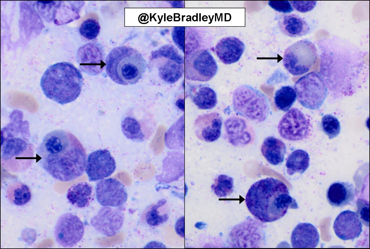 Kyle Bradley, MD on X: Megaloblastic neutrophils in bone marrow