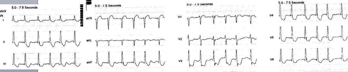 What is the culprit artery? Not what you think. hqmeded-ecg.blogspot.com/2017/04/what-i…