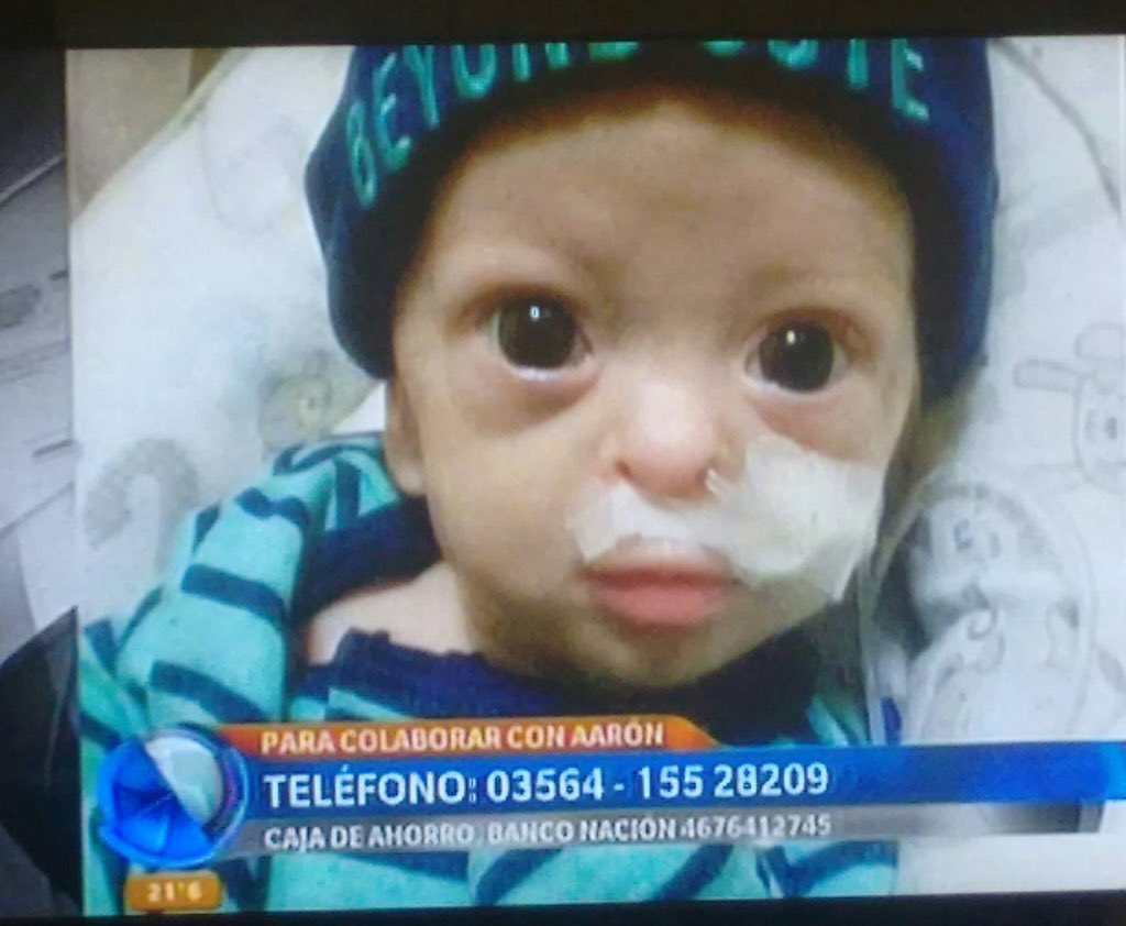 camucha4's tweet photo. Tiene 5 meses y sufre del síndrome de Johanson Blizzard, es el único caso en Argentina. Ayudemos a su familia que lo necesita!!! https://t.co/ncDn2pLXCm