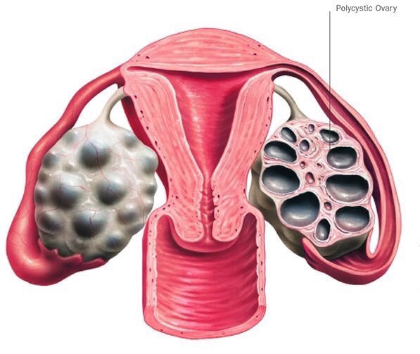 Мультифолликулярный поликистоз яичников что это. Лапароскопический дриллинг яичников. Поликистоз яичников (спкя). Дриллинг яичников при спкя. Поликистозная структура яичников.