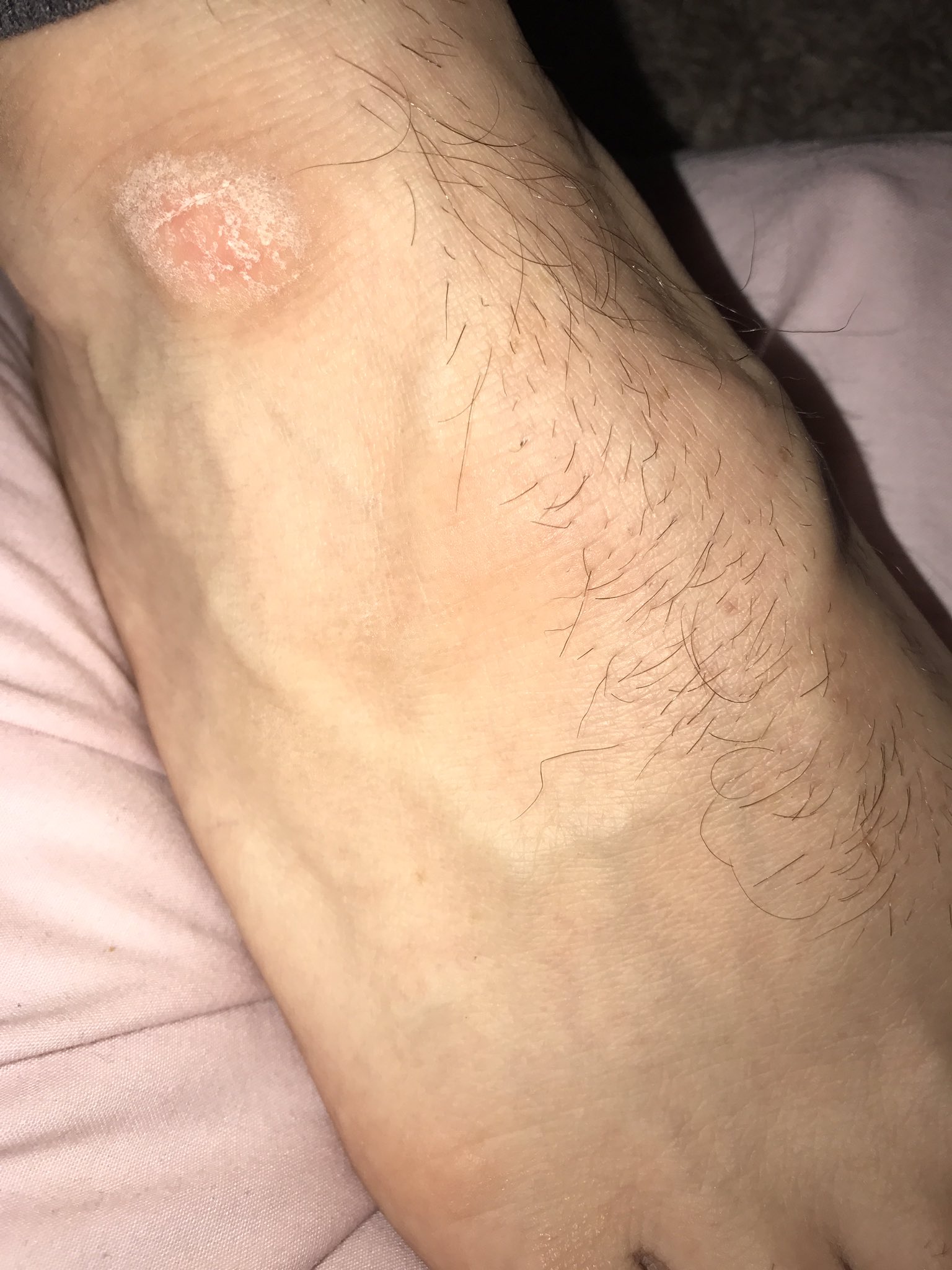Dead skin cheap on ankle