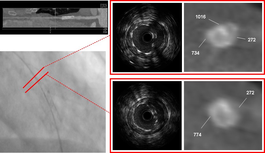 srdeleiras's tweet image. Remember the case we&apos;re presenting in #CSC15? We exemplified how #CTA is the most sensitive test to detect #stentfracture &amp;gt; preferent tool