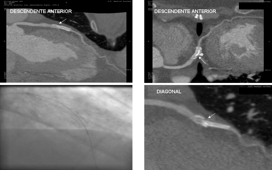 srdeleiras's tweet image. Remember the case we&apos;re presenting in #CSC15? We exemplified how #CTA is the most sensitive test to detect #stentfracture &amp;gt; preferent tool