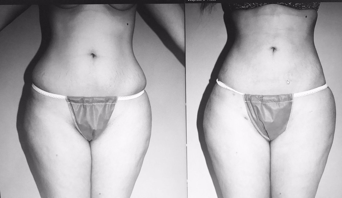 TJ_LIPO's tweet photo. The Brazilian Butt Lift by @drjaimecampos  #BBL #PlasticSurgery https://t.co/1N3ns5owI0