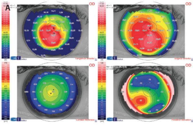CRST_global's tweet photo. The distortion of the cornea in keratoconic eyes makes #IOLcalculation more complex. Read more: https://t.co/PABFrM9Exk #ophthalmology https://t.co/uVItny8WkU
