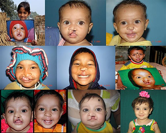SmileTrainIndia's tweet photo. The innocent smiles of these children are a symbol of their strength! RT if you agree! #PowerOfASmile https://t.co/t3inaWKPpA