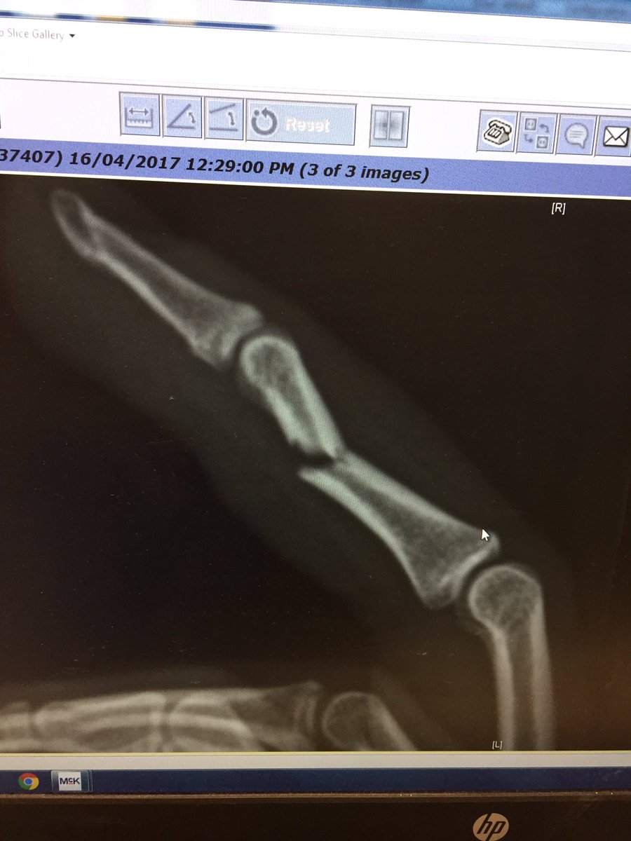 nicolestaz's tweet photo. I'd like to thank the girl from Hamilton for slashing my finger in half https://t.co/3rm7vuHW4c
