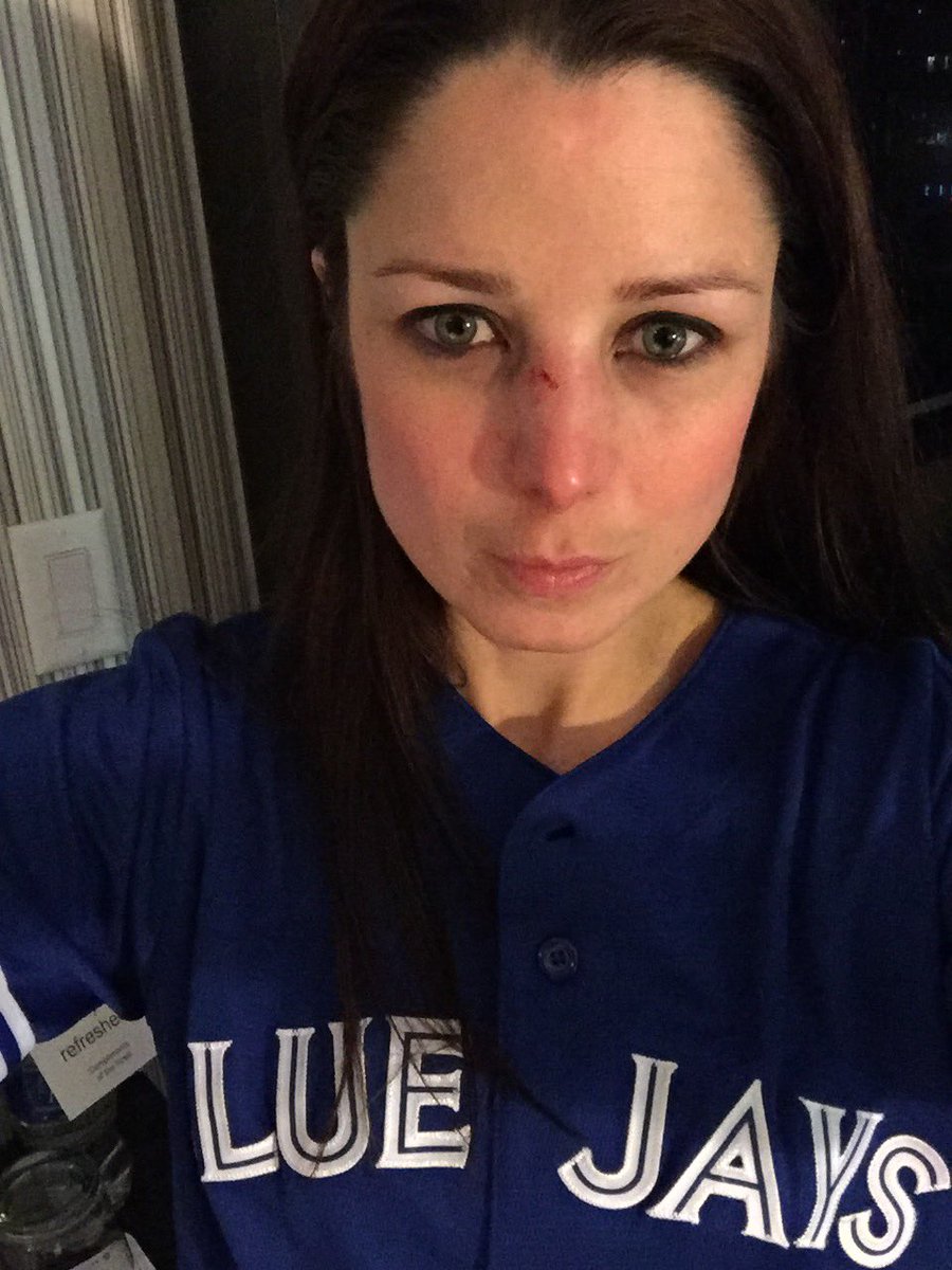 jaykwelyn's tweet photo. Hey @GrillCheese49, your 9th inning pitch to Smith caused me this #gameface #brokennose #torontobluejays https://t.co/rtZeJXQPrk