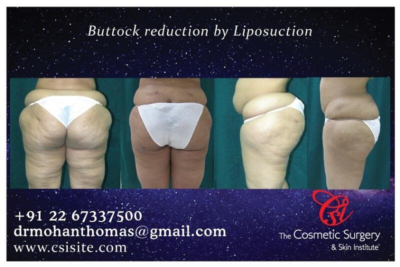 # lipo360 # 3Dlipo 
#VASER#LASER#SMARTLIPO#cosmeticsurgery #CosmeticSurgeryInstitute 
MUMBAI INDIA CSISITE.COM 
+912226617575