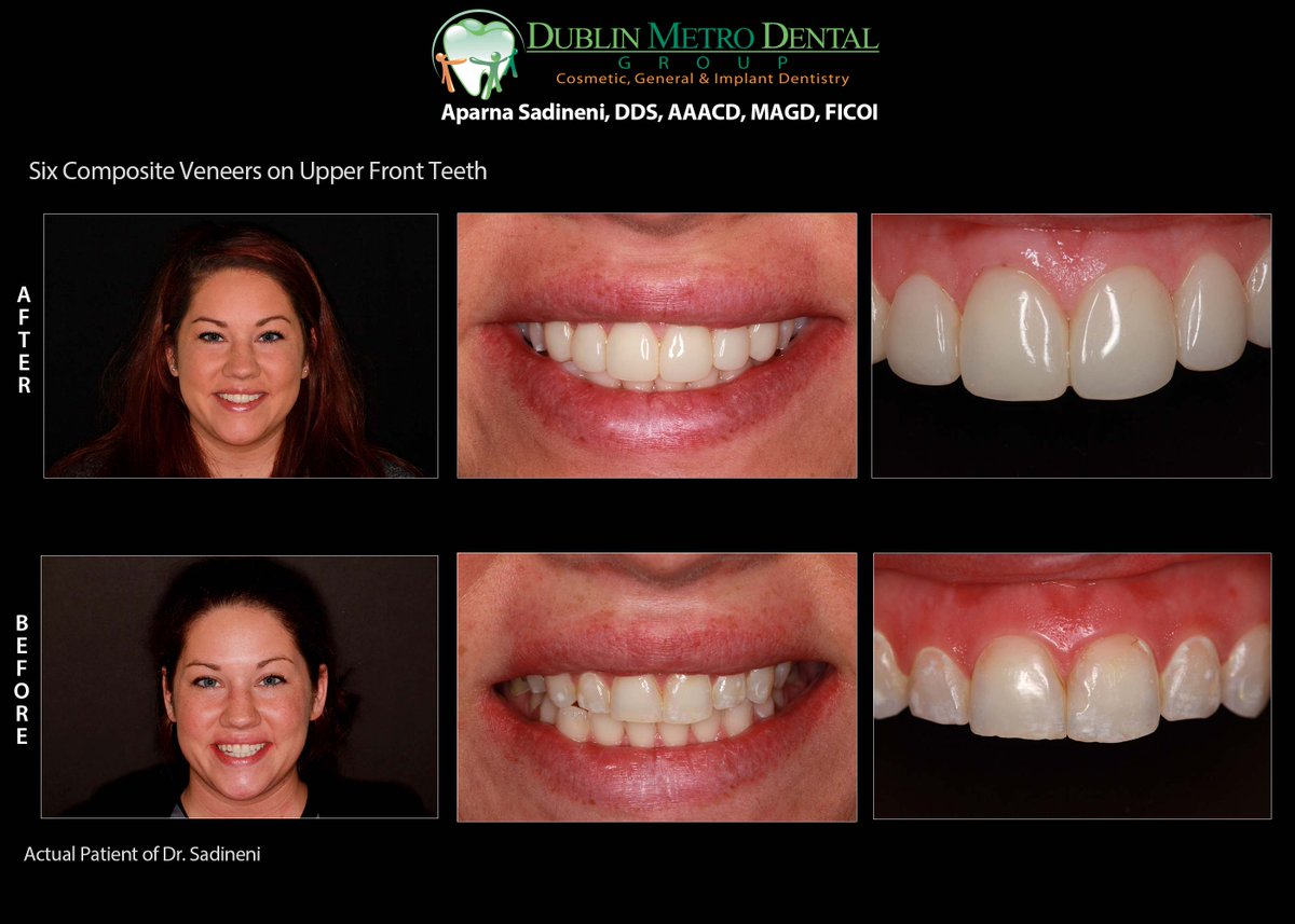 DMDGroup's tweet photo. Celebration of Excellence Month Dr. Sadineni AACD Case - 6 Composite Veneers #DMDSmiles #SmilesByDMD #AACD #AACD2017 #DMDpatients https://t.co/vZFboDyEFV
