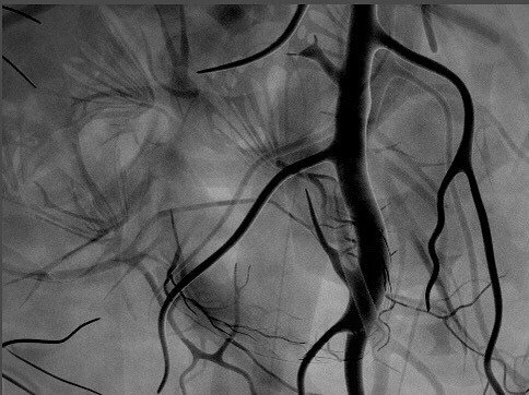 A test render I did a while back for my coronary angiogram animation. Completed video will be uploaded soon!  #may… ift.tt/2pt4DHT
