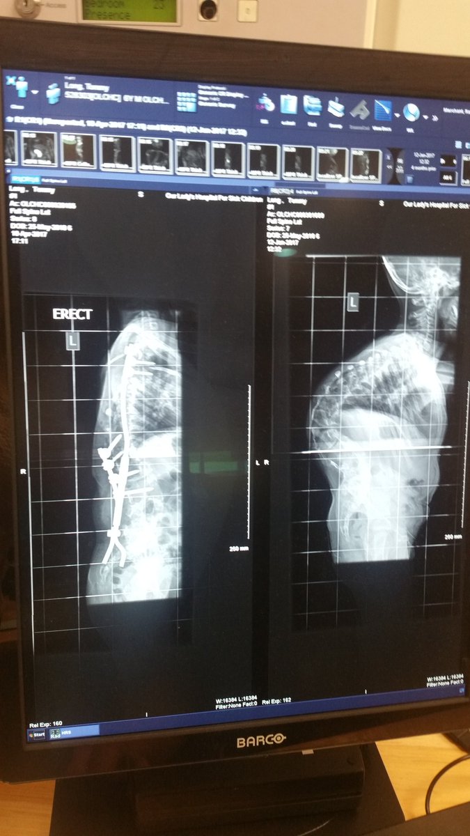 chelleylong's tweet photo. Before and after pic. Amazing surgical skills. Life changing. Shows what can be done. End the wait @SimonHarrisTD @scolionetwork @orlaryan https://t.co/JyFIRR9akB