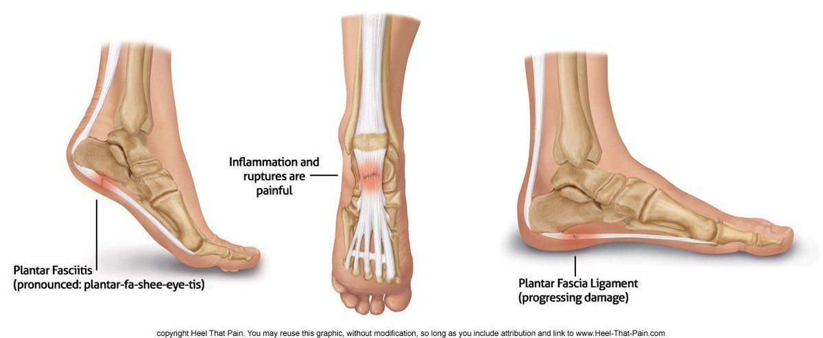 Research has shown massage &amp; acupuncture to be successful at reducing the pain &amp; inflammation of plantar fasciitis. serenityspaoc.com