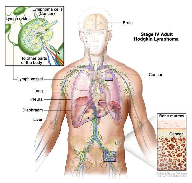 The FDA has approved pembrolizumab (Keytruda®) for some adult and pediatric patients with classical Hodgkin lymphoma cancer.gov/news-events/ca…