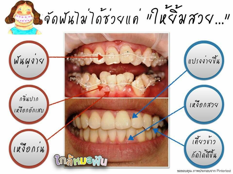 ลักษณะฟันปกติ