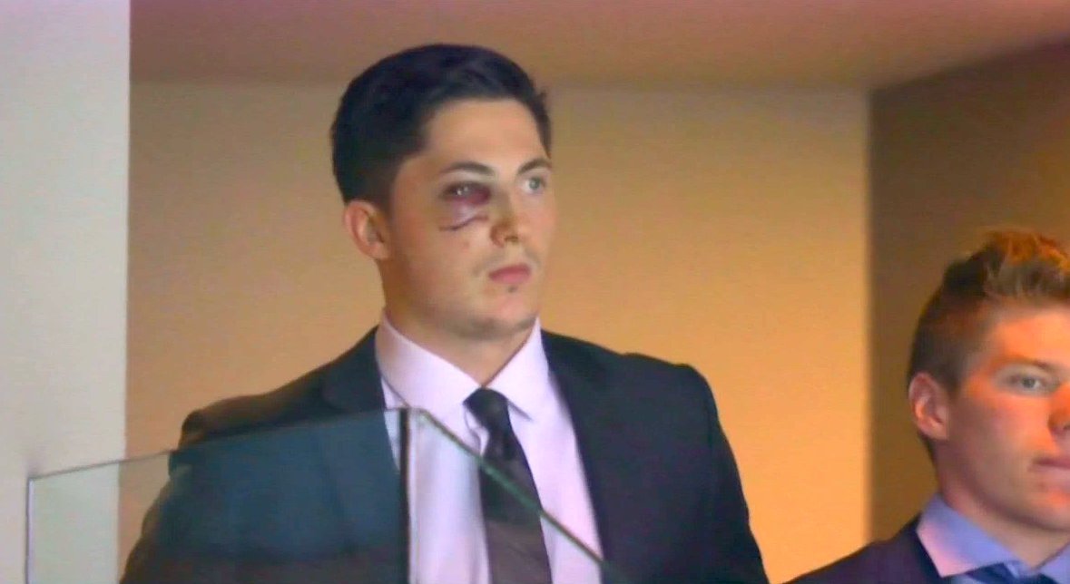 PeteBlackburn's tweet photo. Zach Werenski looks like a terrifying Bond villain with that scar/shiner https://t.co/uRifg3M0lB