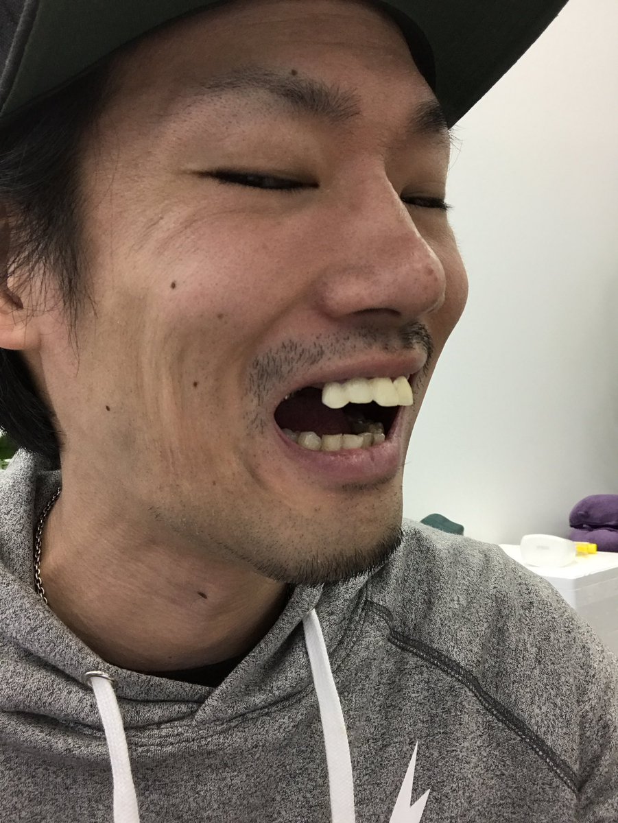 Moya モヤ In 大阪 歯医者に通うこと３年 抜歯のため仮歯すら付けれず歯無しでずっとyoutubeやってました 動画の度に見えないように笑ったり喋ったりで引きつった表情をしておりました そして 今日ついに 念願の歯が着きました ホントに