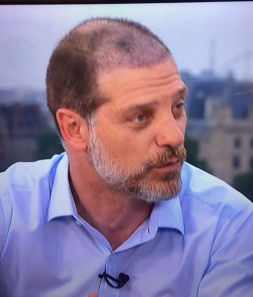 The Hair Transplant Monitor Thread Current Affairs Tfk