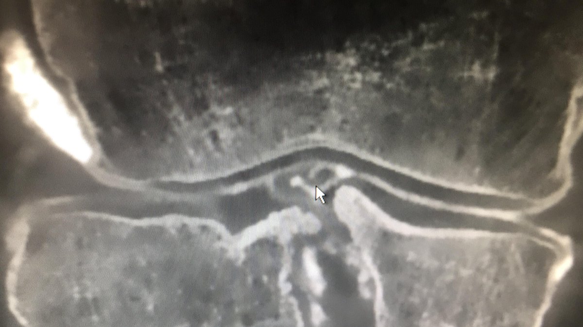 Instituts Guirado (@inst_guirado) on Twitter photo Plastia de LCA. #ArtroCBCT que demuestra rotura de la misma, no detectada en RM de alto campo. Nueva utilidad de #CBCT? por <a href="/JORDICATMARCH/">JORDI CATALA MARCH</a> Plastia de LCA. #ArtroCBCT que demuestra rotura de la misma, no detectada en RM de alto campo. Nueva utilidad de #CBCT? por <a href="/JORDICATMARCH/">JORDI CATALA MARCH</a>