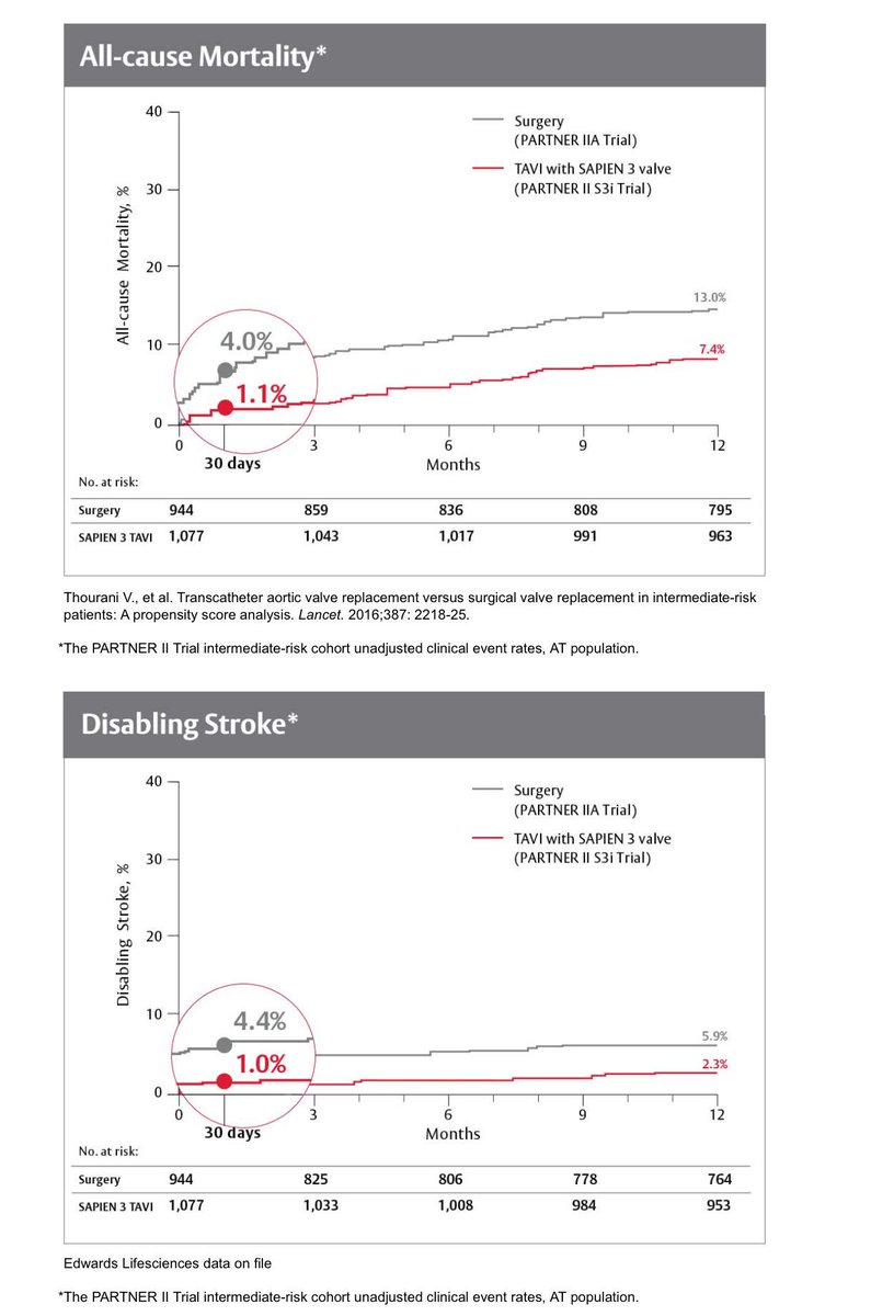 "Amazing results for transcatheter aortic valve implantations in intermediate risk patients" ~<a href="/drmkmittal/">Mayank Mittal, M.D.</a> #tavr #tavi <a href="/TheLancet/">The Lancet</a>