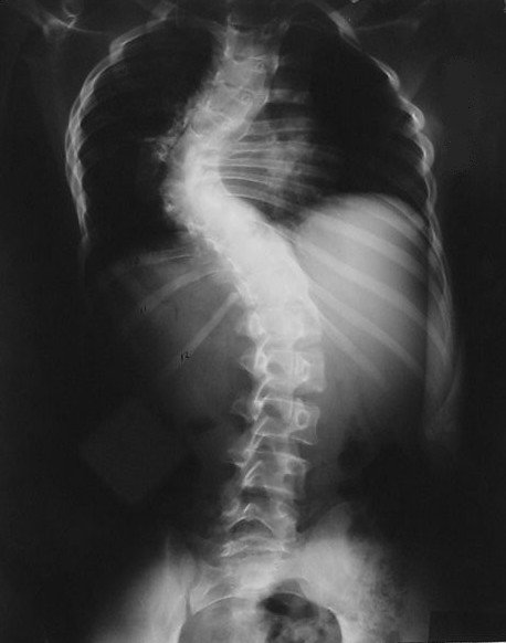 ATX_Chiro's tweet photo. Long Term Study Shows Improvement of #Scoliosis with #Chiropractic https://t.co/M2jyUOMeAX #atx #Austin #backcurve #chiropractor #spine https://t.co/KqwL2UENzS