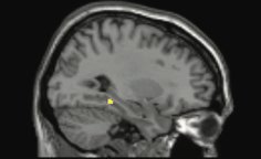 NIH_Innovates's tweet photo. Brain scans reveal that estrogen can alter memory in some women &amp; may underlie differences in mental disorders https://t.co/YvxcBwliVI https://t.co/hkgfrD1bem