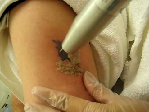 ScalpDoctor's tweet photo. #TheTattooIndustry 03/25 at 11am CST with #ATHASD on @DFWiRadio
#tattooremoval @TheeTattoo @SCENEchicago @Funky_Sak http://t.co/GRoJPgXIwv