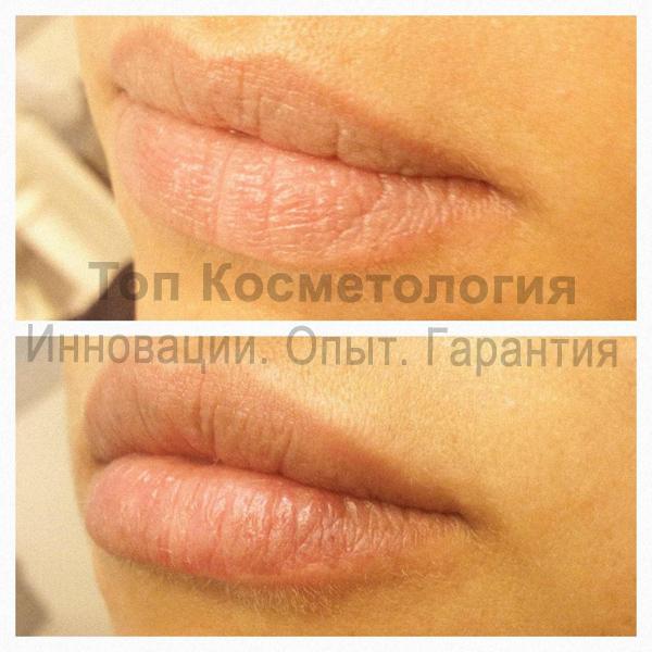 #Увеличение губ #скидка 40% - ВСЕГО 1920 грн. от Топ #Косметология (depilclub.com.ua):ldays.com.ua/catalog/kupon/…