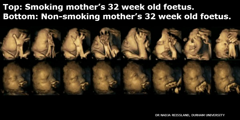 What do these 4-d scans tell us about the impact smoking during pregnancy has on a foetus?

bbc.co.uk/programmes/p02…