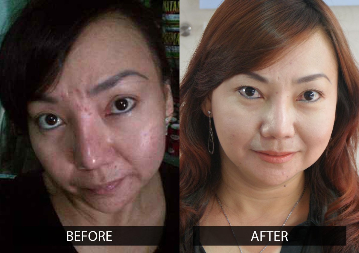 MaskerAlami_ID's tweet photo. Mau punya wajah putih merona, bebas flek &amp; jerawat?yuk Invite Pin: 27A2E248 , HP 08562097812 JANGAN TUNDA! http://t.co/F2ax13MVZU