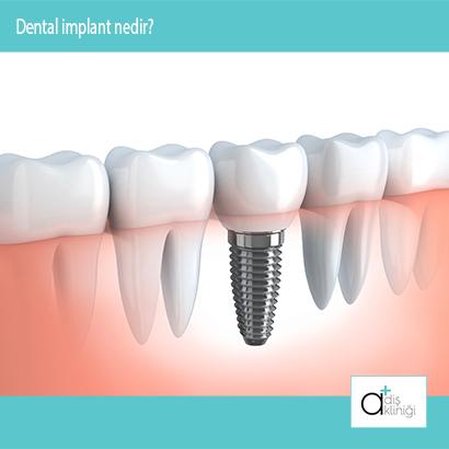 Eksik olan dişlerin fonksiyon ve estetiğini tekrar kazandırmak amacıyla çene kemiğine yerleştirilen yapay diş köküdür
