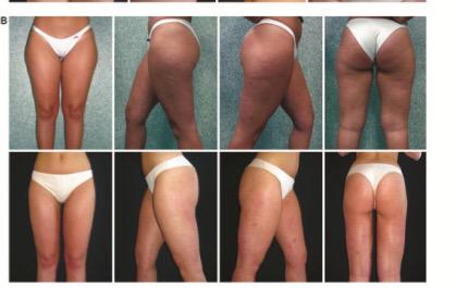 ProShockIce's tweet image. Destroy fat, reduce size, tighten skin, improve cellulite - look better! #summerbody