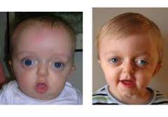 Crouzon's syndrome triad: brachycephaly, exophthalmos &amp; midfacial hypoplasia. A FGFR-2 mutation. 75% AD inheritance.