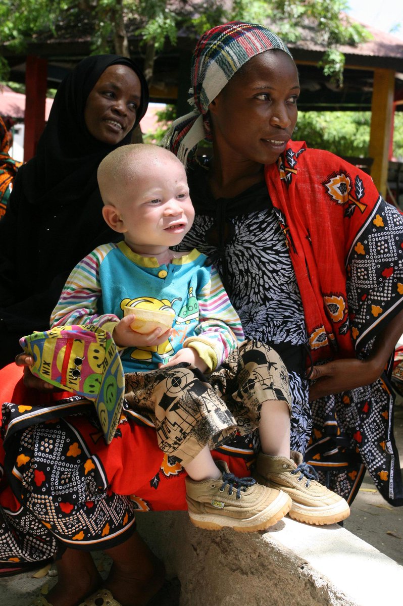 Африка белая женщина. Альбиносы африканцы Танзания. Афроамериканец альбинос.
