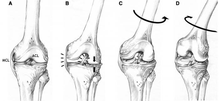 premiumhs_'s tweet photo. "@fisioterapia_es: Regreso al deporte post reconstrucción del LCA http://t.co/FDem8XYEQy http://t.co/goBXcl7LLu" @SaludSport @STARPREMIUM_EP