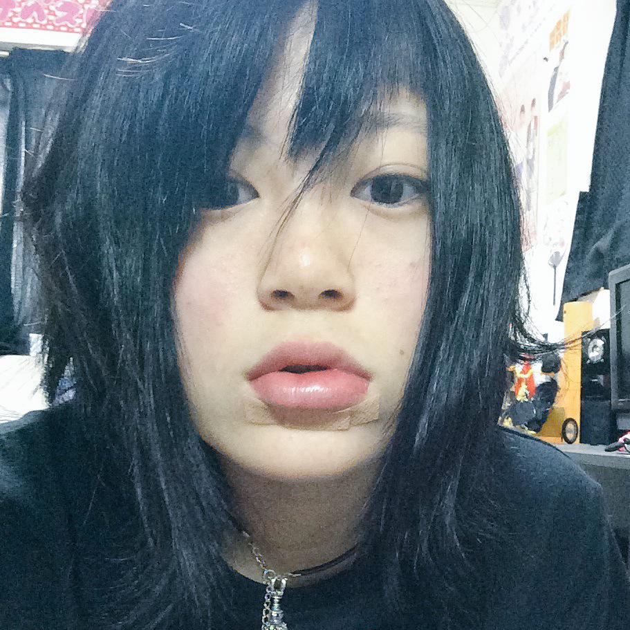 Ramu 朝の唇の腫れ具合がヤバかったwww 絆創膏 Http T Co Celrpigdj5 Twitter Ramu 朝の唇の腫れ具合がヤバかったwww 絆創膏 Http T Co Celrpigdj5 Twitter