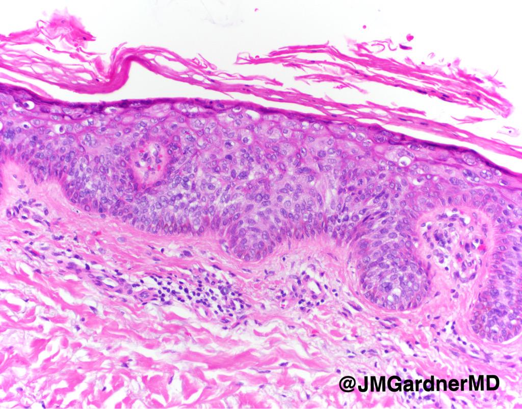 squamous cell carcinoma in situ histology