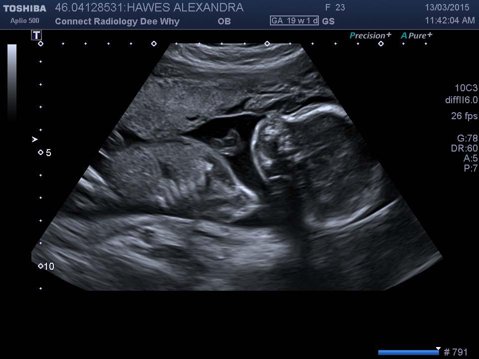 HawesAlly's tweet photo. 19 weeks 4 days pregnant. http://t.co/K7JwU6ZokN