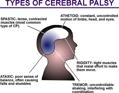 Belajar lagi  mengenai jenis-jenis Cerebral Palsy dalam bulan #CPAwareness  Jika ada pertanyaan, please just ask....
