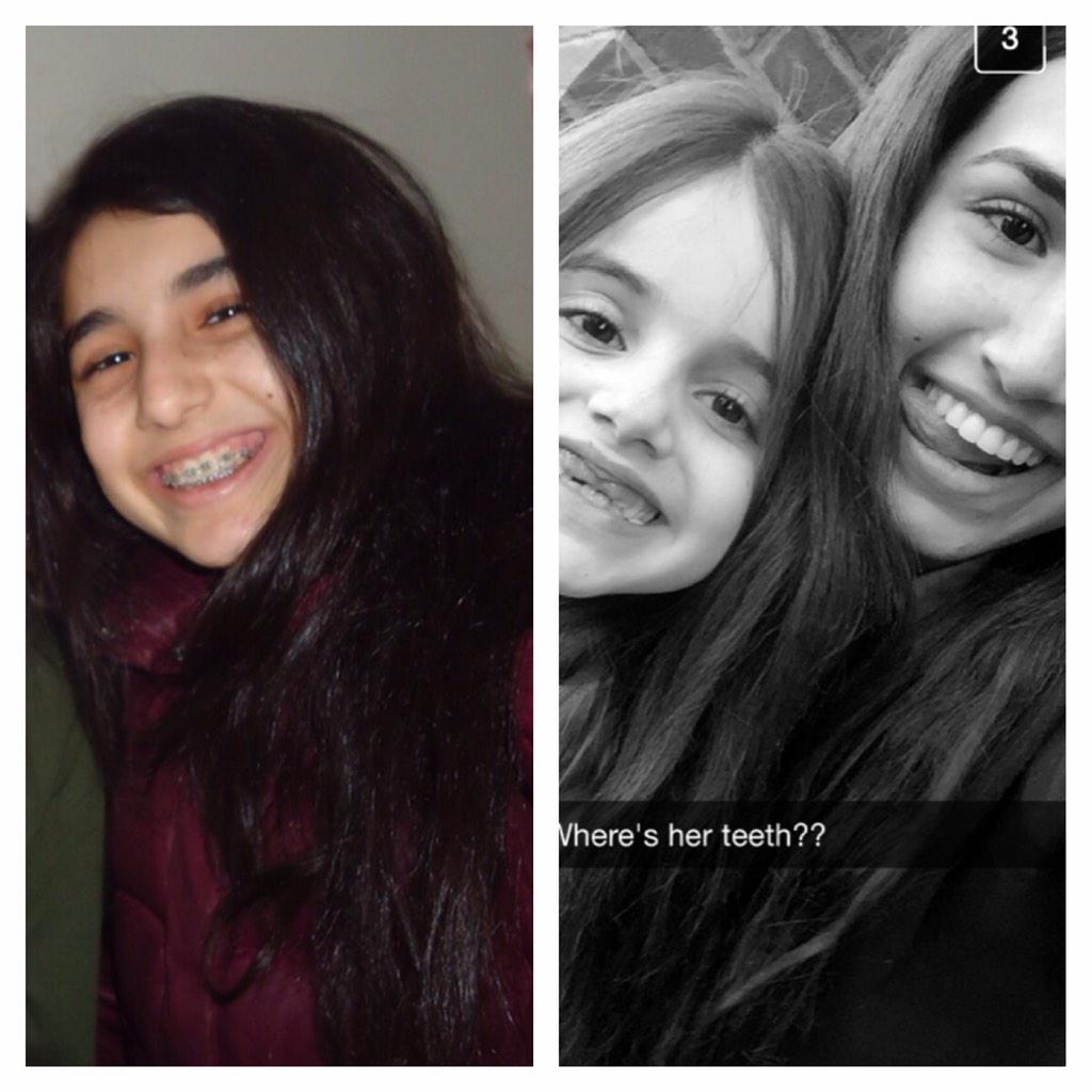 lorisardar's tweet photo. Look who's finally braceless! #transformation http://t.co/2jvBOGYmm5