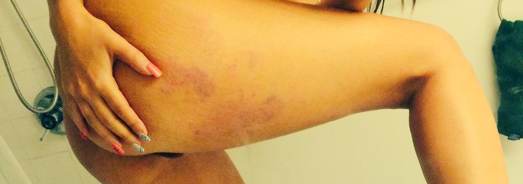 anonymous0slut's tweet photo. #spanked #bruised and really really sorry @Lendl97 http://t.co/gUSwS5hPwf