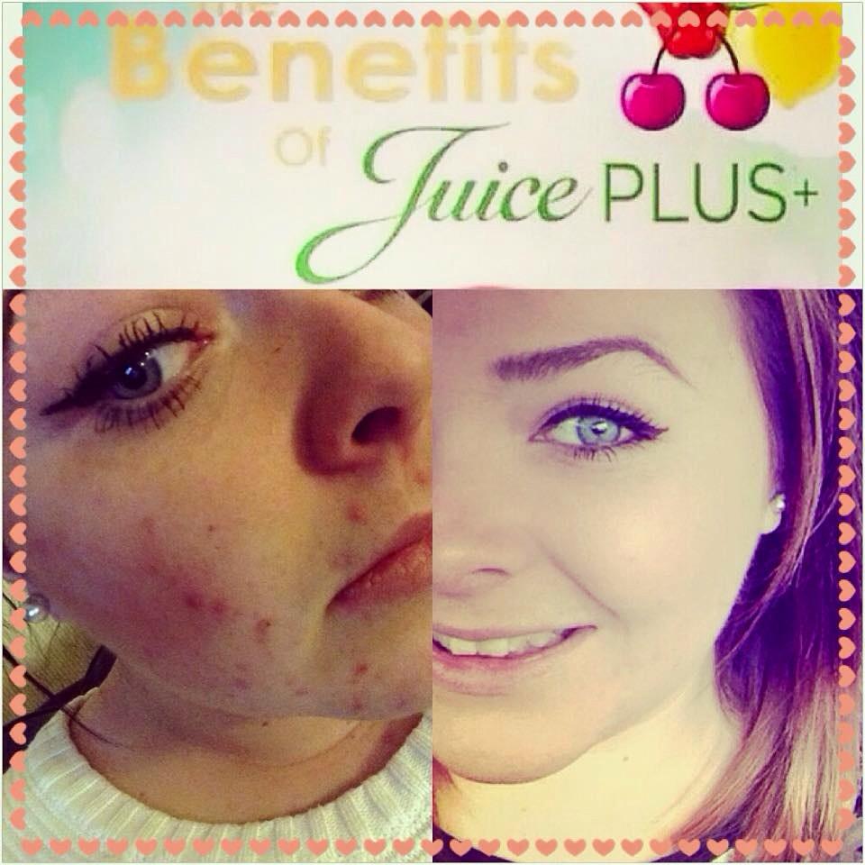 LGBodyBeautiful's tweet photo. Our Berry capsules are insane 🍇🍇 the results are life changing!! Especially for hair, nail and skin 💜💜💜 http://t.co/oDNQTjwDMu