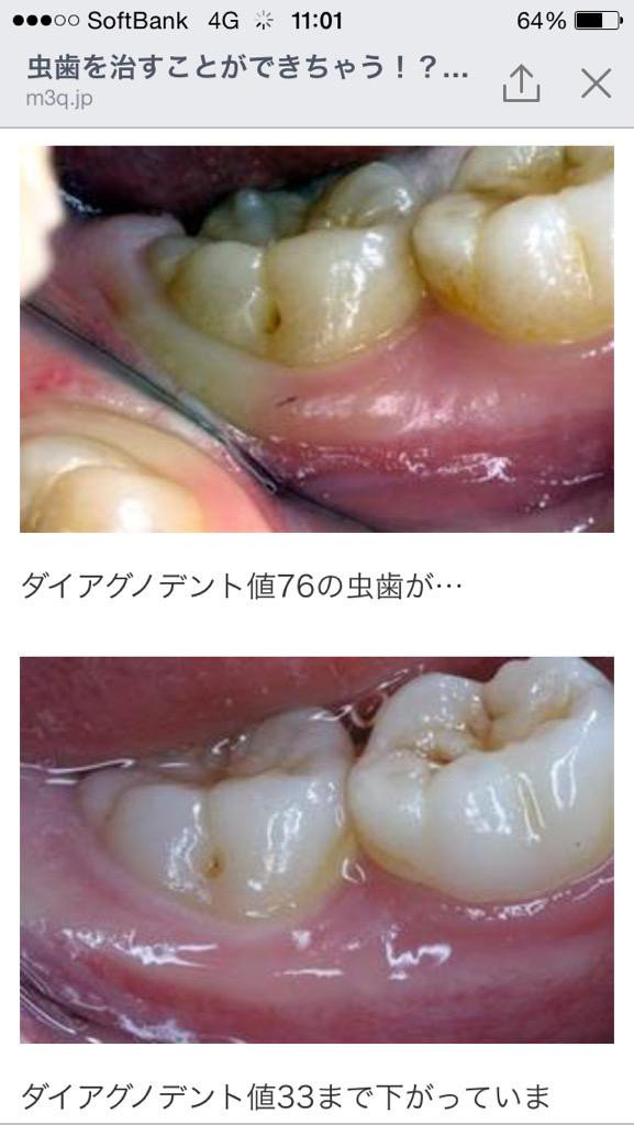 山下陽光 虫歯を治すことができちゃう 重曹での歯磨きがスゴい Http T Co Wt8xrsakpz 歯磨きも効果あるけど 重曹うがいで こんなにも歯が白くなって 虫歯も治る 治るってどういう事だ と思った方 ガン見 Http T Co Mgntnhi91f Twitter