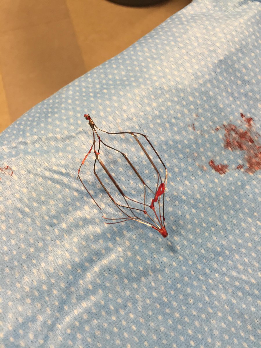 MountSinaiIR's tweet photo. No #IVC filter left behind...2 years later. #Optease @RSP516 http://t.co/qoNb5J1JI3